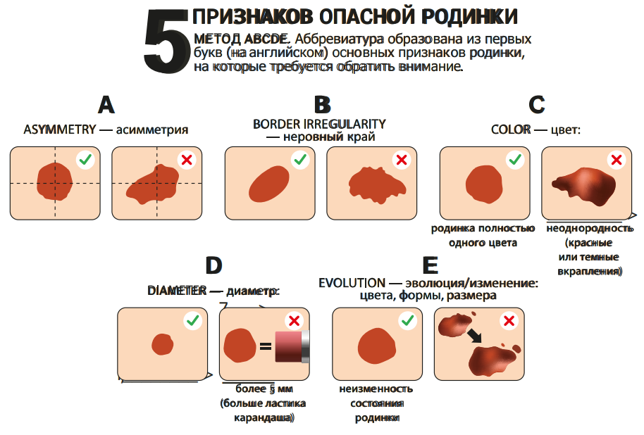 Удаление родинок радиоволновым методом - последствия, стоимость и отзывы