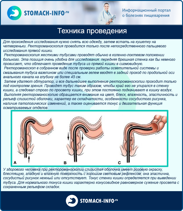 Ректороманоскопия кишечника - что это такое? подготовка к исследованию, стоимость и отзывы пациентов