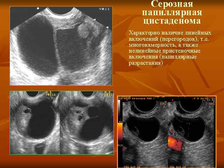 Серозная цистаденокарцинома яичника — гистология, симптомы, лечение и прогноз