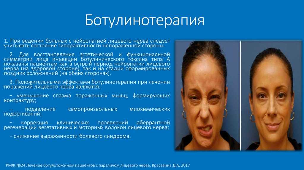 Неврит лицевого нерва