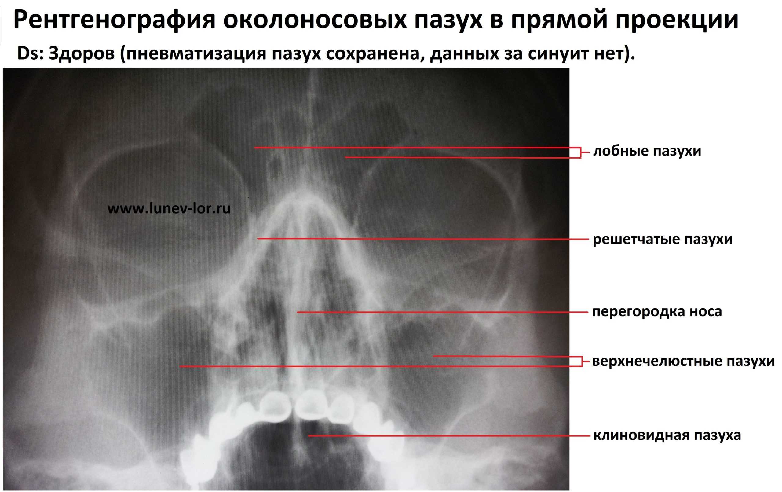 Как выглядит гайморит на рентген снимке