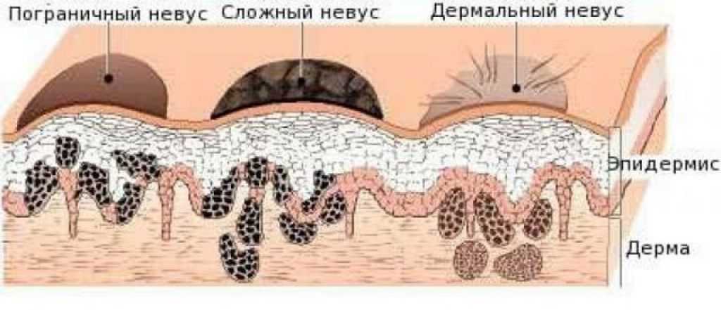 Папилломы: симптомы, причины, диагностика, лечение и профилактика
