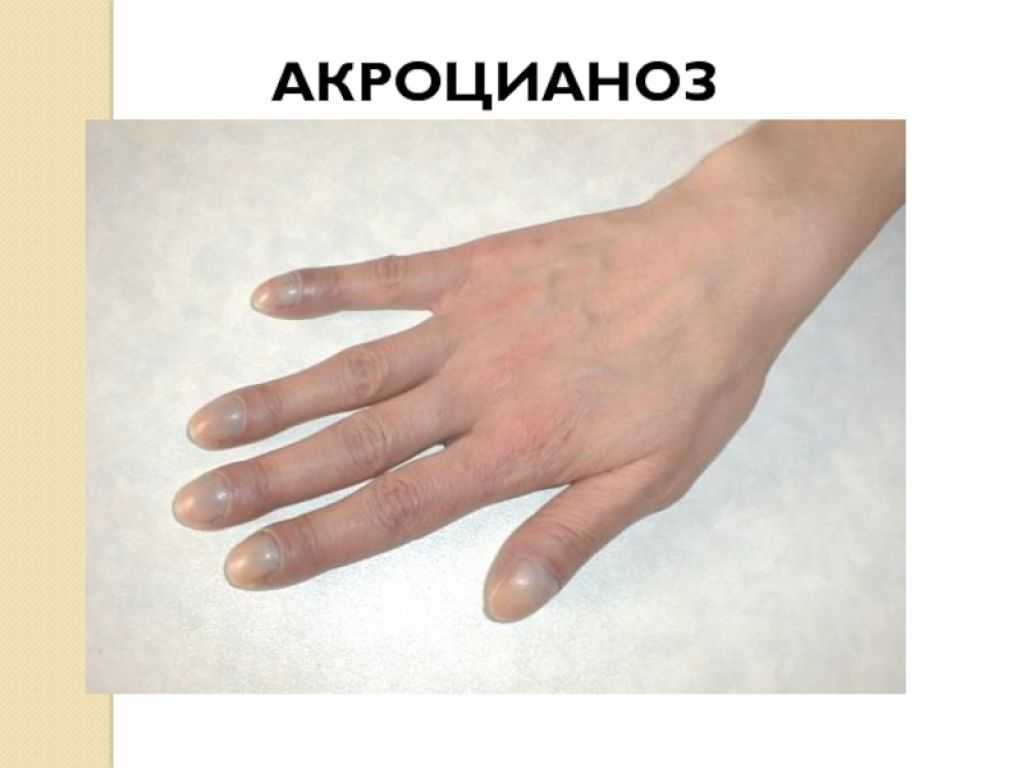 Acrocyanosis: definition, causes, and when it’s a concern