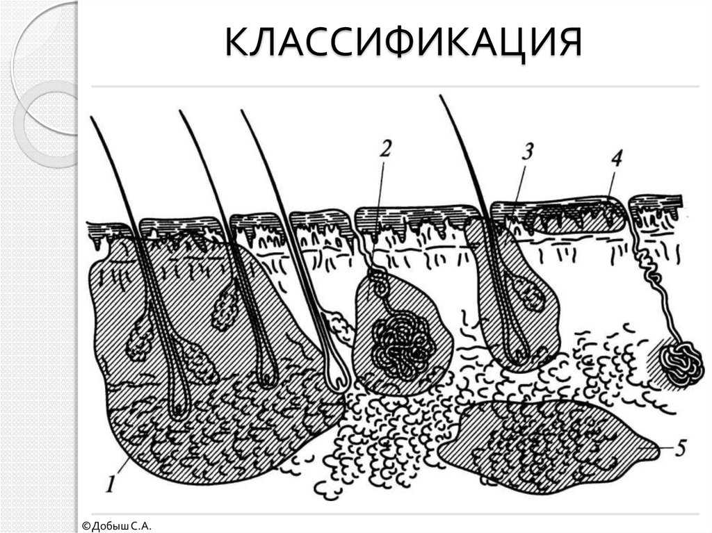 Карбункул и фурункул: отличие, классификация, симптомы