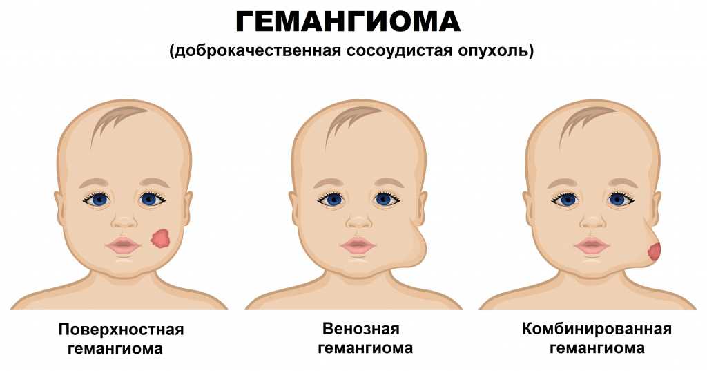 Как распознать и лечить гемангиому у новорожденных  Гемангиома у новорожденных – как распознать  В первый месяц жизни крохи, когда малыш только