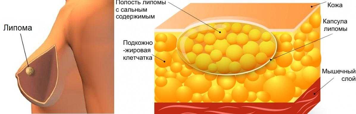 Фиброма: виды, симптомы, проявления, лечение, надо ли их удалять