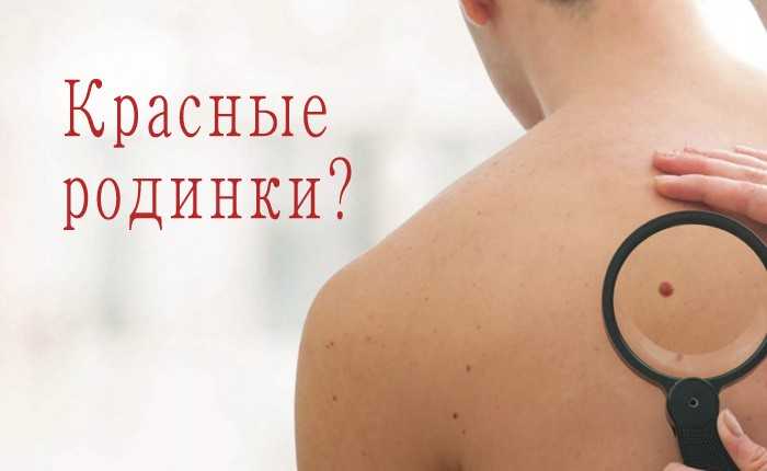 Красные родинки. что это такое?