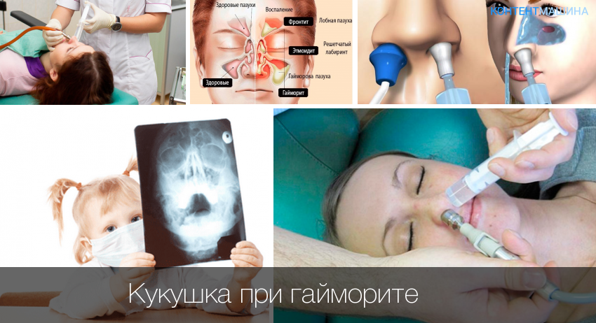 Промывание придаточных пазух и носа с вакуумом