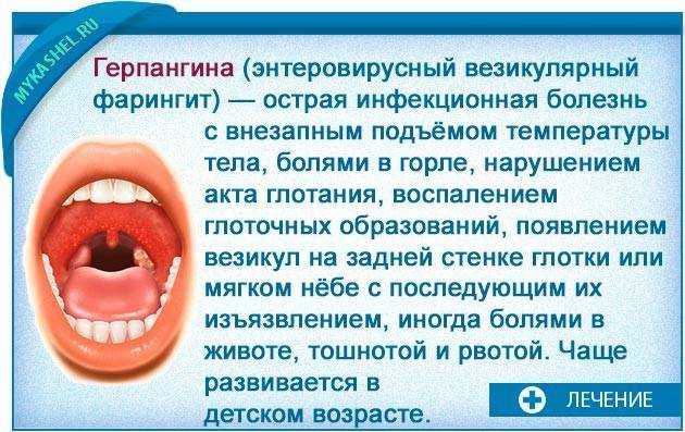 Симптомы и признаки ангины