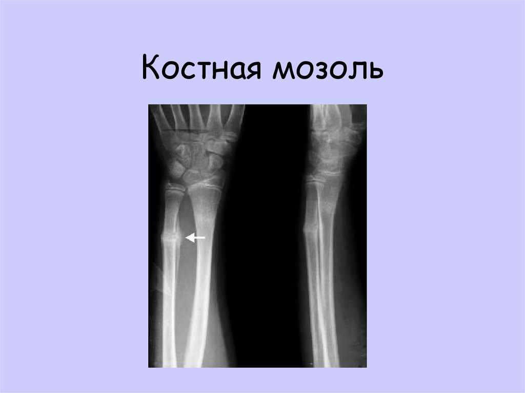 Что такое консолидированный перелом