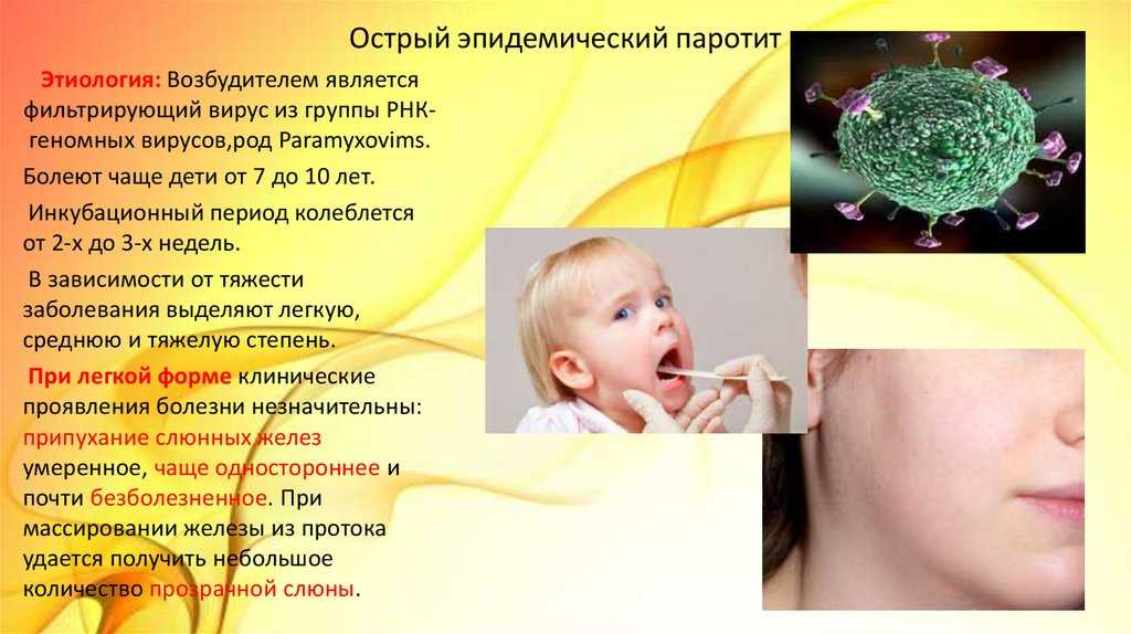 Эпидемический паротит (свинка)
