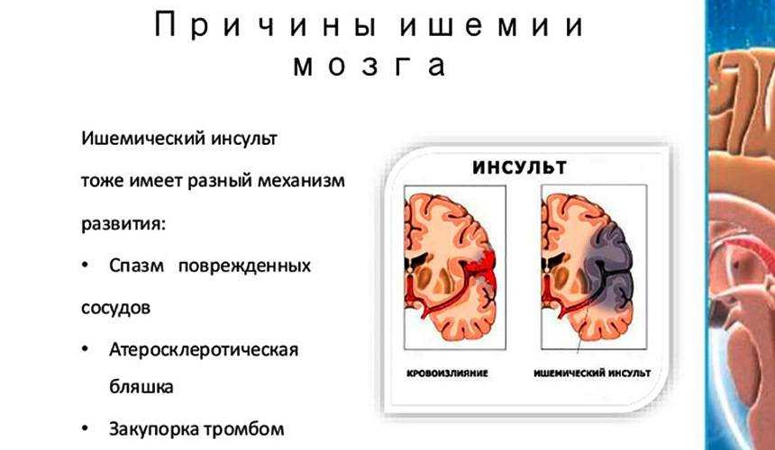 Ишемический инсульт: прогноз для жизни, последствия, симптомы, особенности пожилого возраста