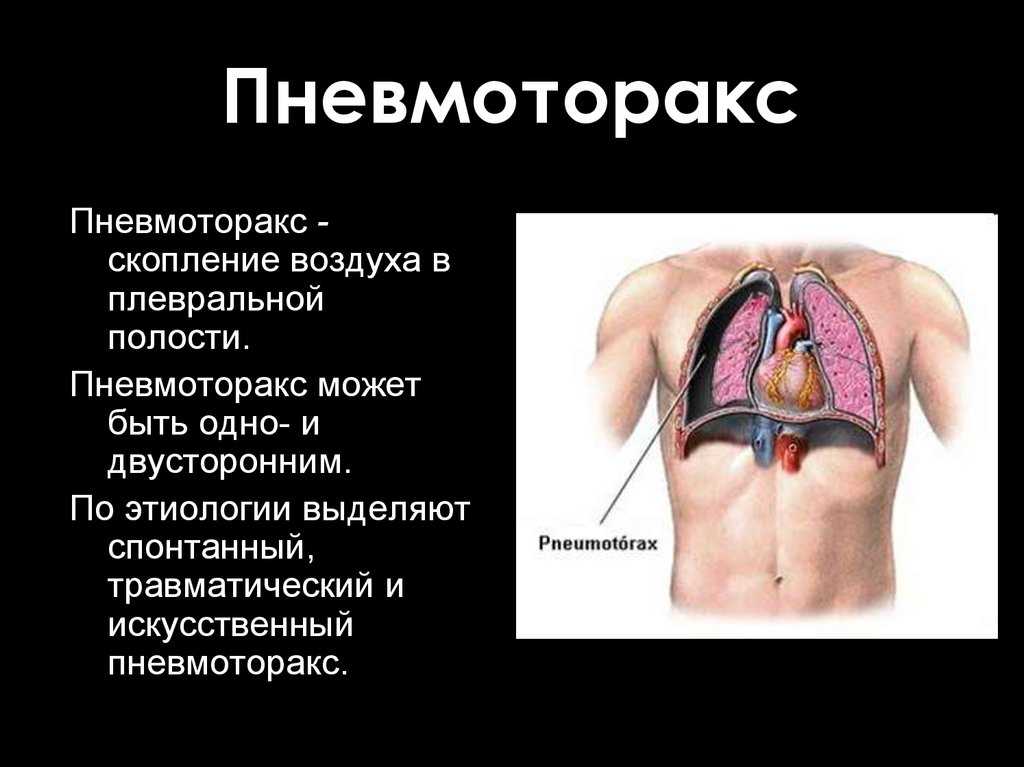 Ушиб легкого: что делать