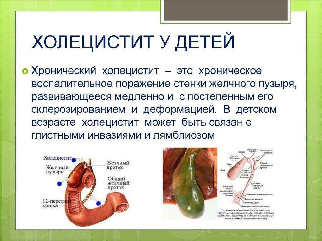 Гипомоторная дискинезия желчного пузыря