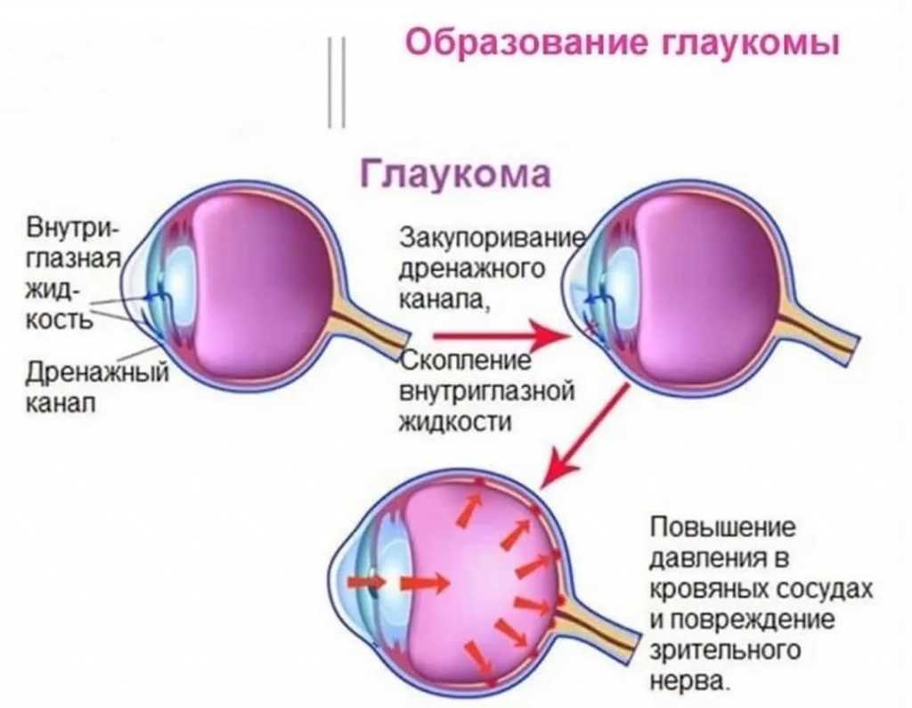 Открытоугольная глаукома: лечение, симптомы и рекомендации