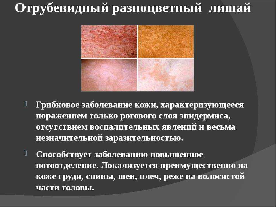 Розовый лишай