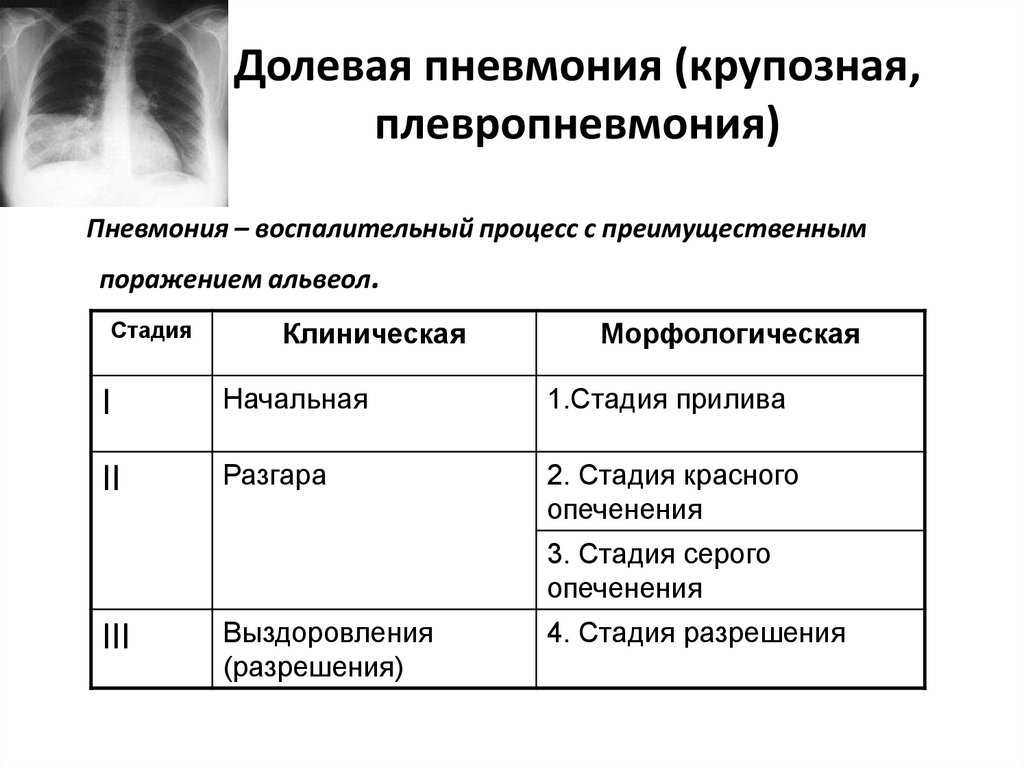 Что такое бронхопневмония, какими симптомами проявляется и какое лечение требует это заболевание