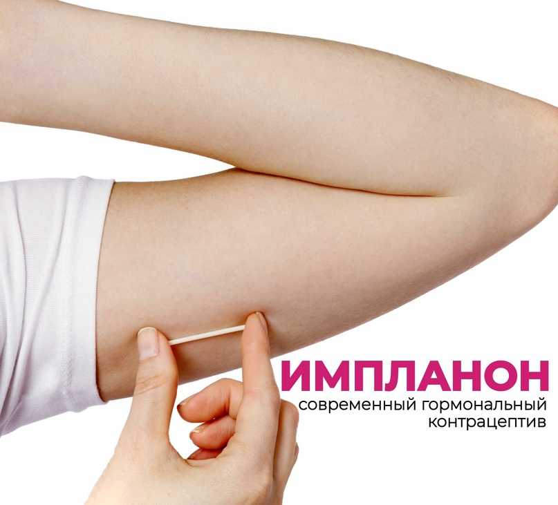 Имплантат implanon nxt 68 мг для подкожного введения - медицина - 2024