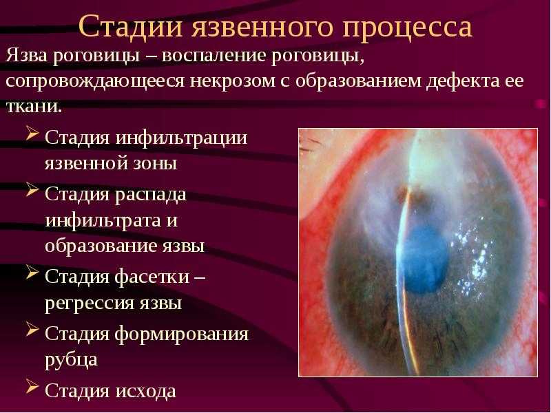 Капли от коньюктивита