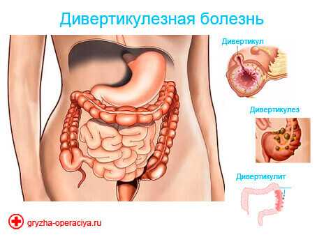 Диета при дивертикулезе сигмовидной кишки — примерное меню