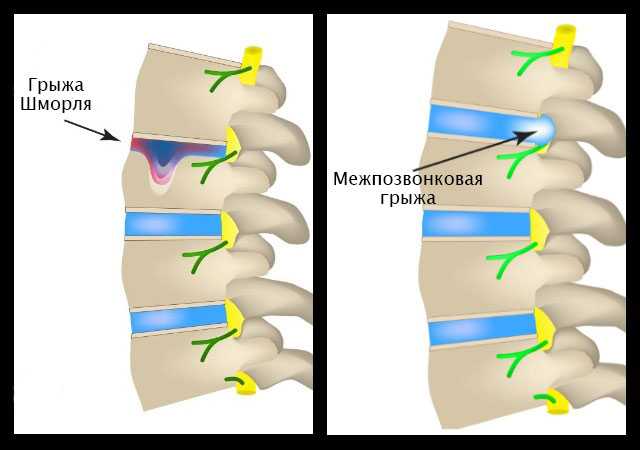 Мелкие грыжи шморля в телах позвонков: лечение, диагностика и симптоматика