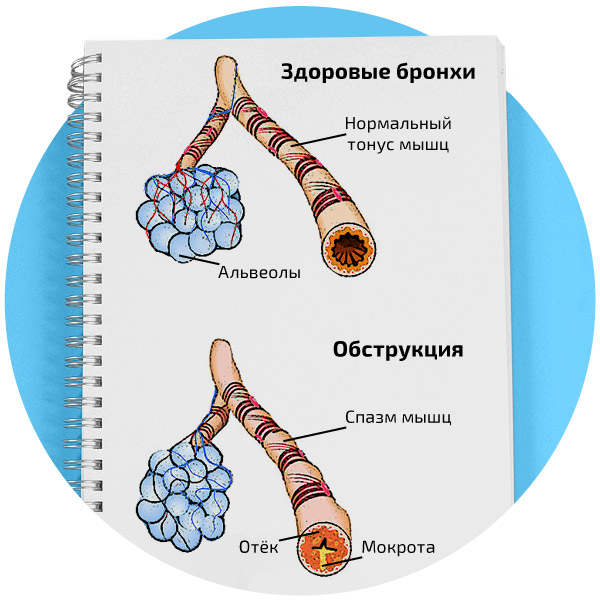 Простой и слизисто гнойный хронический бронхит