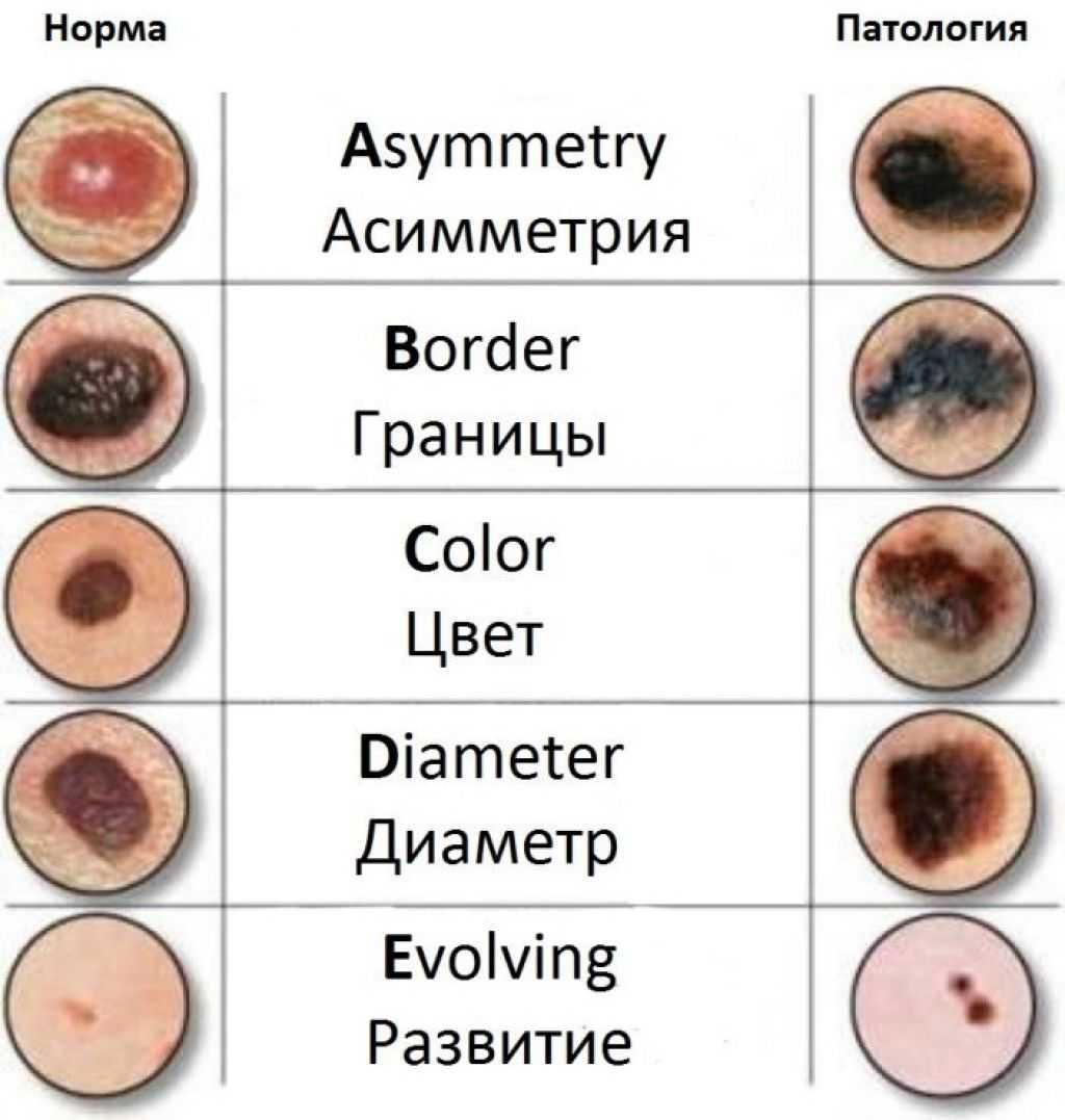 Методы удаления родинок в израиле