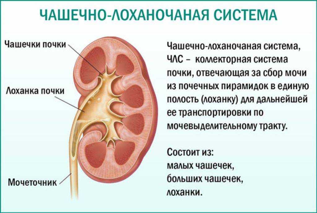 Каликоэктазия почек — что это такое, симптомы и лечение гидрокаликоза у детей и взрослых