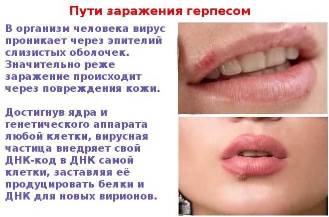 Как не заразиться герпесом: 9 шагов (с иллюстрациями)