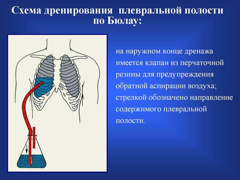 Что такое разрыв легких