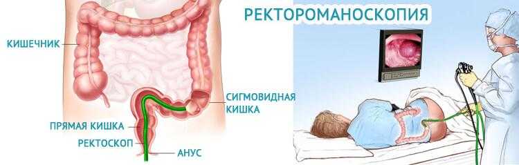 Колоноскопия или ректороманоскопия?