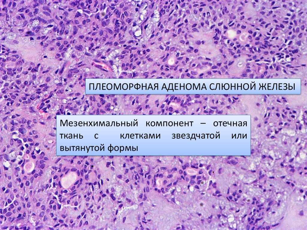 Плеоморфная аденома
