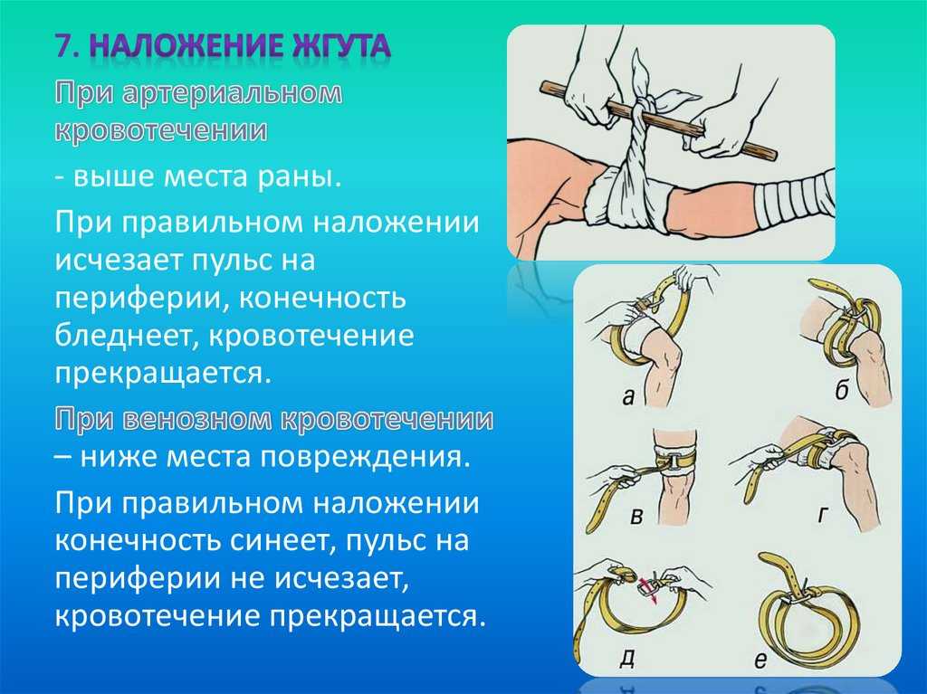 Как наложить жгут при кровотечении