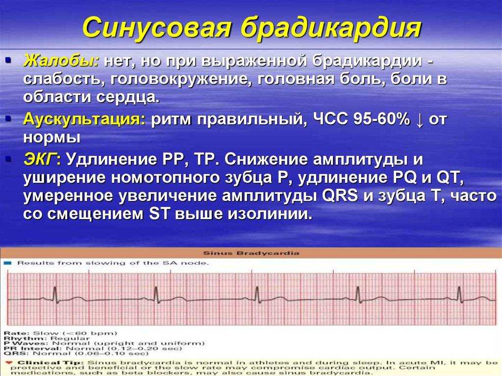 Препараты при брадикардии: список и описание медикаментов
