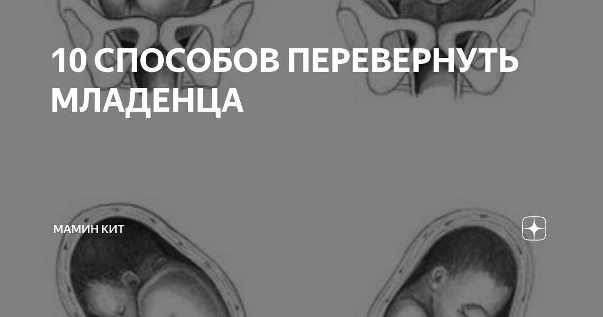 Кесарево сечение при тазовом предлежании плода: что важно знать?