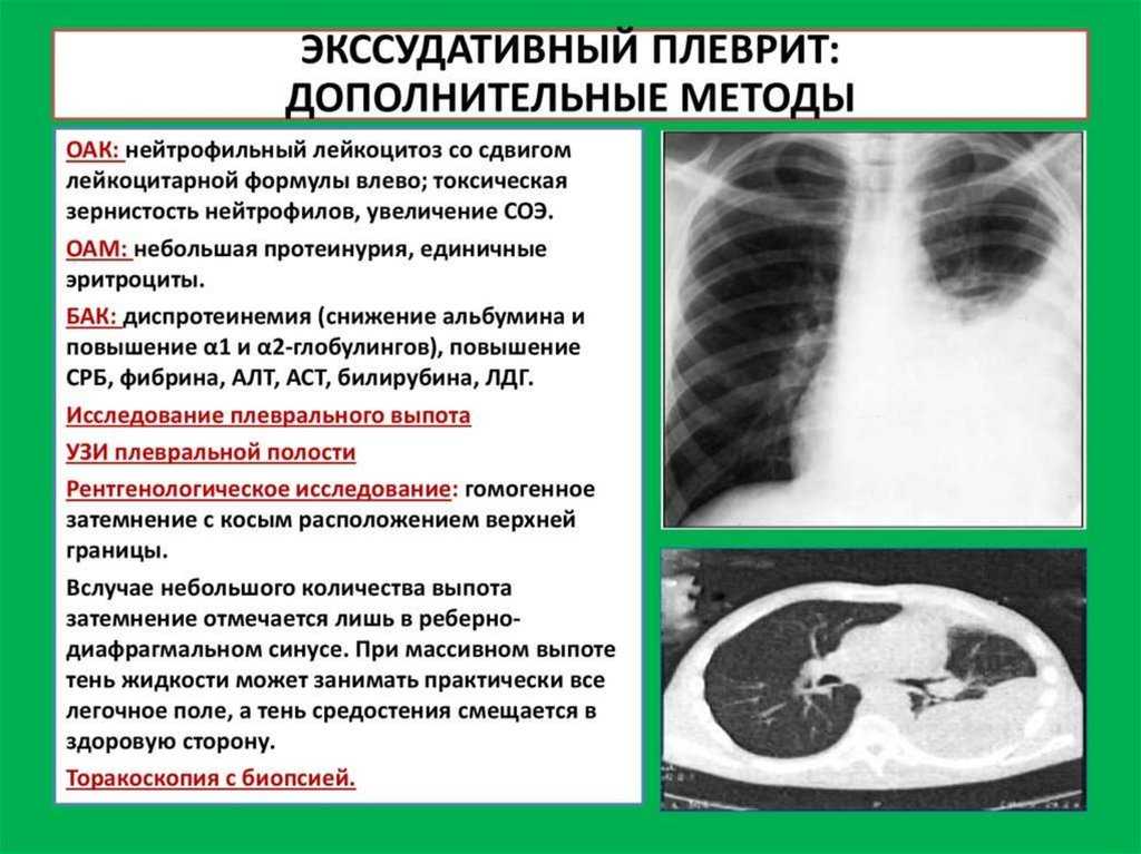 Плеврит: симптомы и признаки сухой и экссудативной формы, причины, лечение, возможные последствия и прогноз