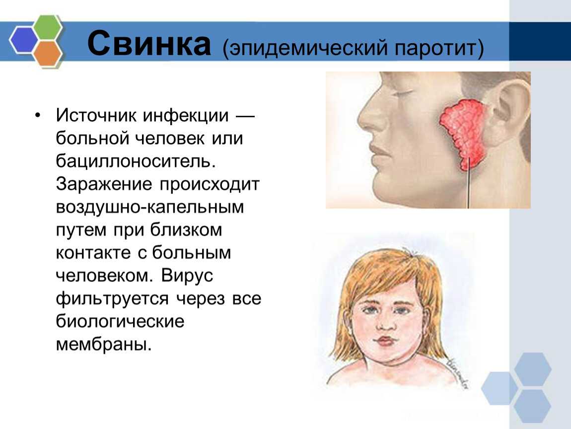 Паротит: симптомы, причины, лечение, профилактика у детей, фото