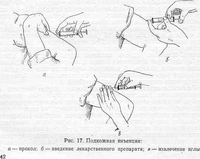 Подкожное введение лекарственных средств: необходимая подготовка и методика проведения | услуги клиники «проксима» (г. сочи)