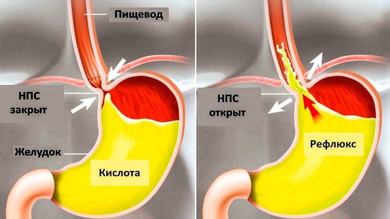 Диета при изжоге: принципы правильного питания, какие продукты можно есть, примерное меню на неделю