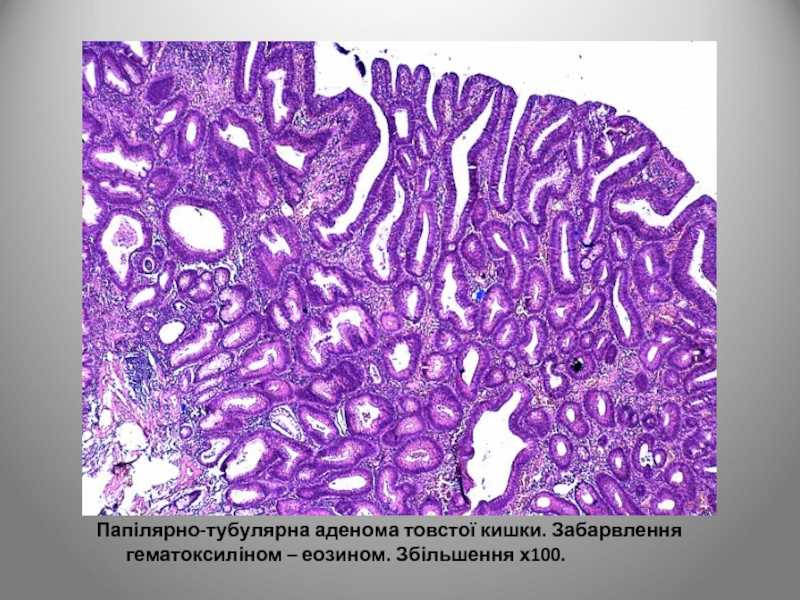 Тубулярная аденома толстой кишки