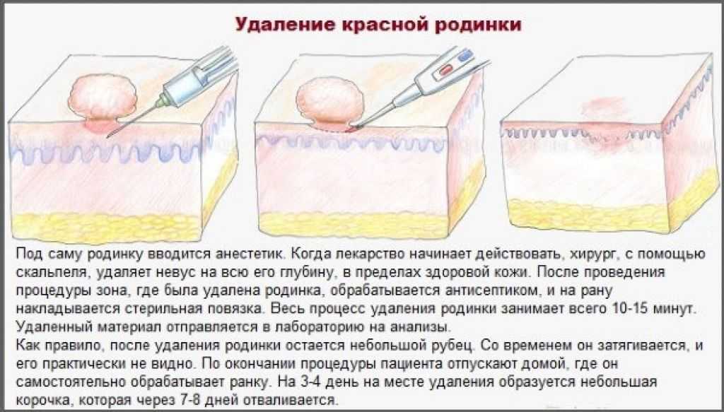 Папиллома человека, лечение, удаление, все о вирусе.