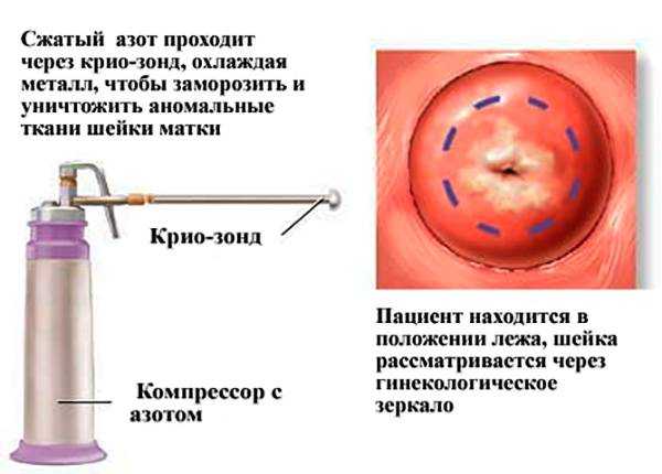 Когда можно беременеть после прижигания эрозии шейки матки лазером