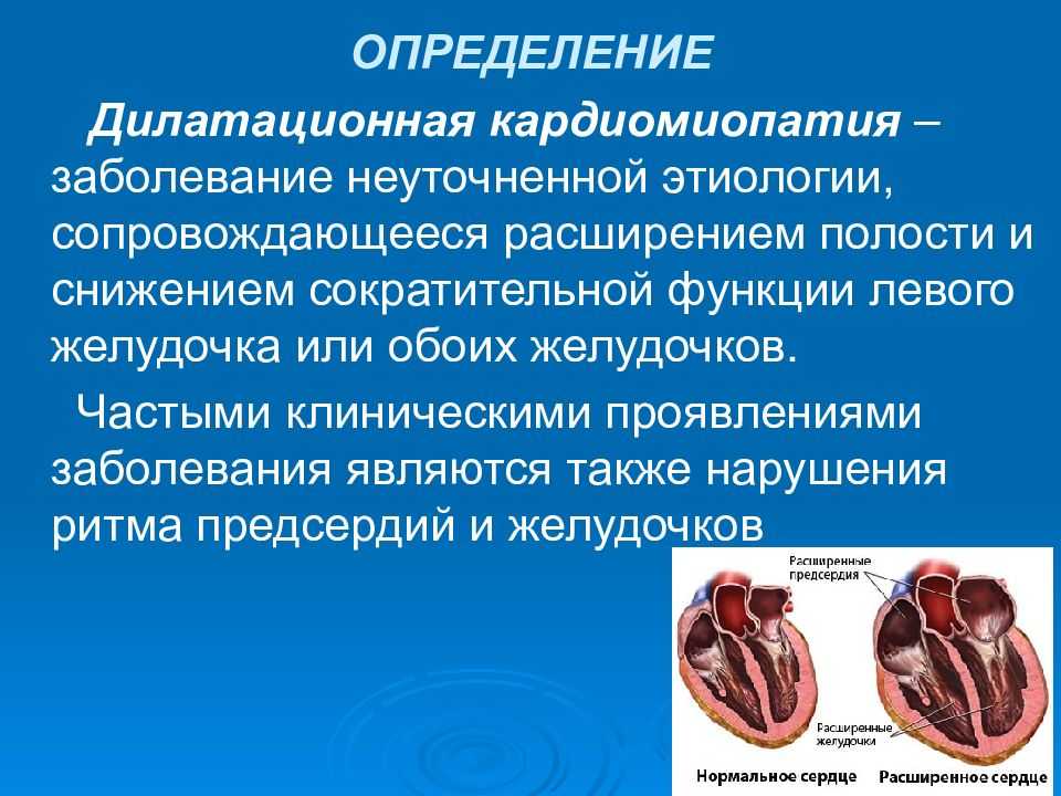 Кардиомиопатия