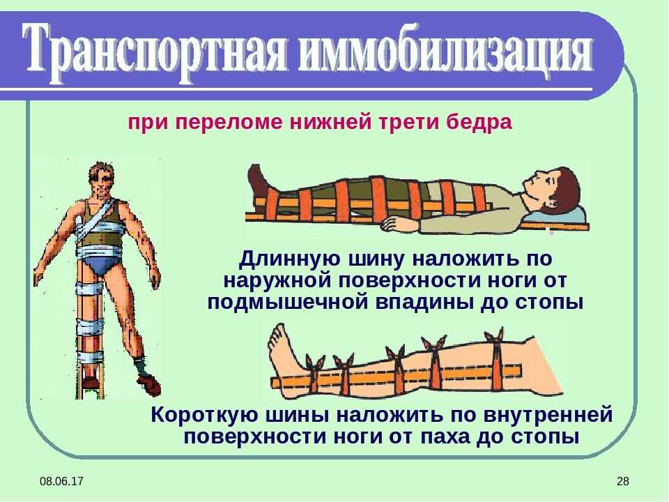 Наложение шины при переломе голеностопа