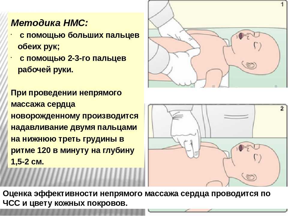 Ателектаз легких у новорожденных: причины, симптомы, диагностика, лечение, профилактика