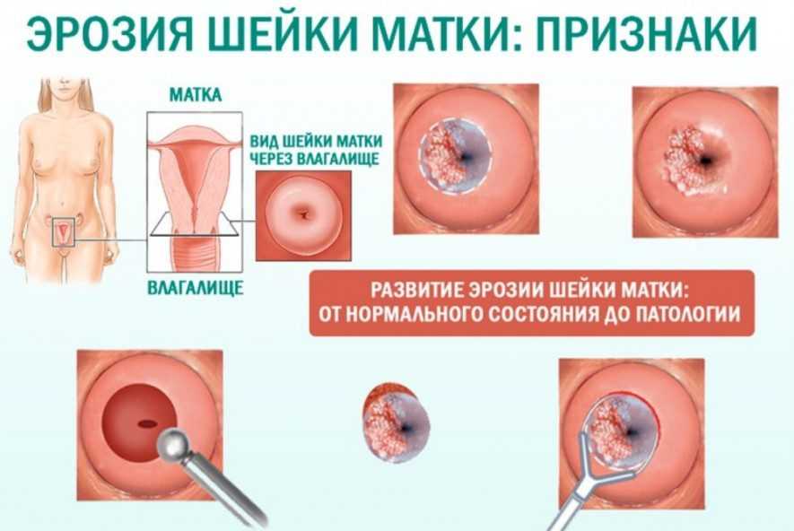 Беременность и доброкачественные заболевания шейки матки. дисплазия шейки матки при беременности