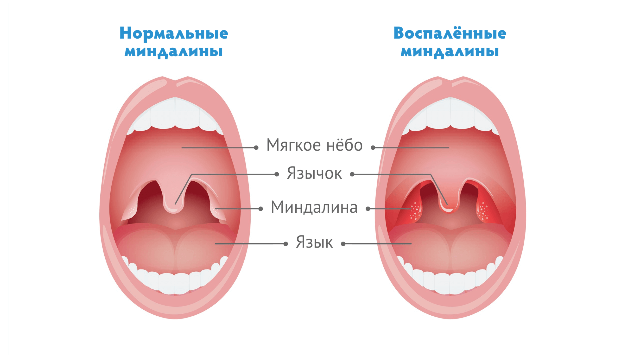 Симптомы, признаки и лечение герпесной ангины у детей