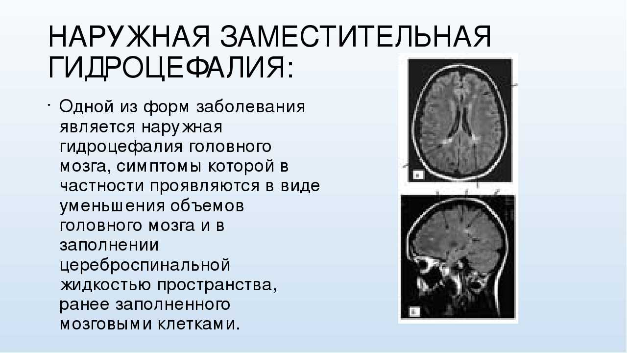 Гидроцефалия головного мозга у новорожденных детей и взрослых