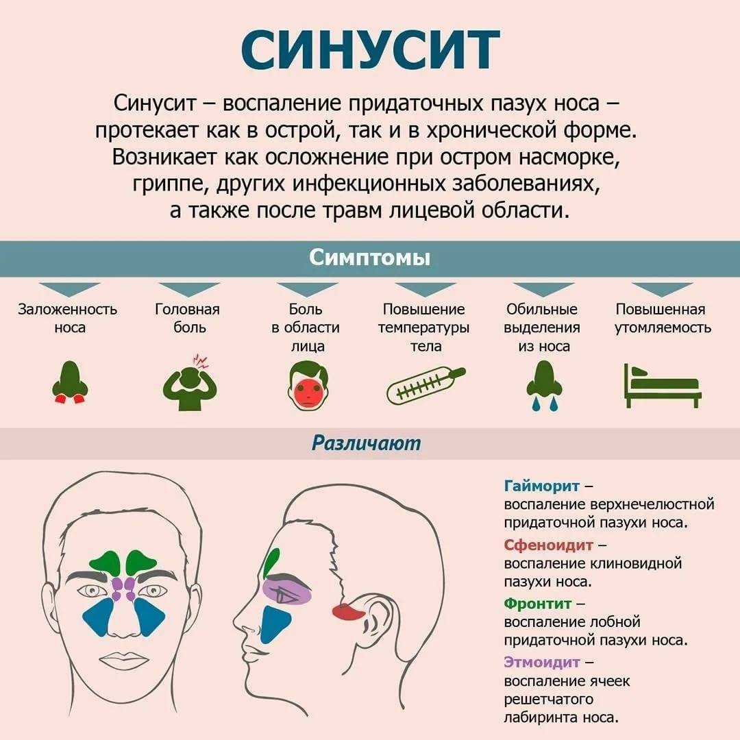 Гайморит – напоправку