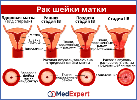 Сколько развивается рак шейки матки | первый медицинский центр тель-авива